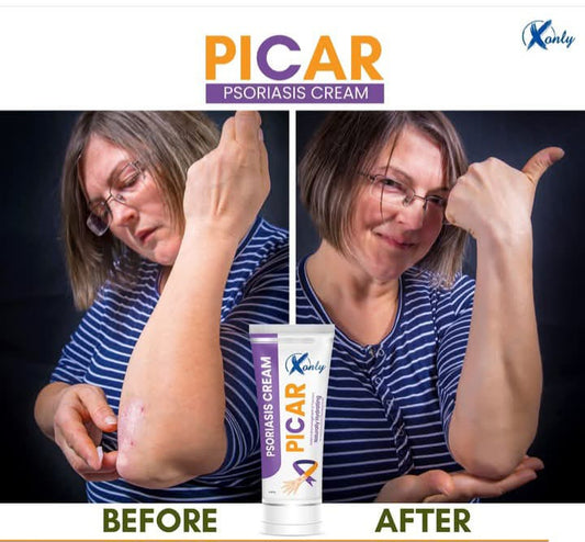 Picar Psoriasis Cream - Naturally Hydrating Relief for Psoriasis